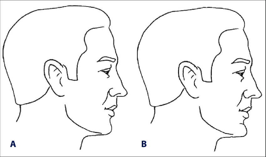 Chin Type-
Two different types of chin: normally prominent (A) or somewhat flatter chin and a type of prominent chin (B). 